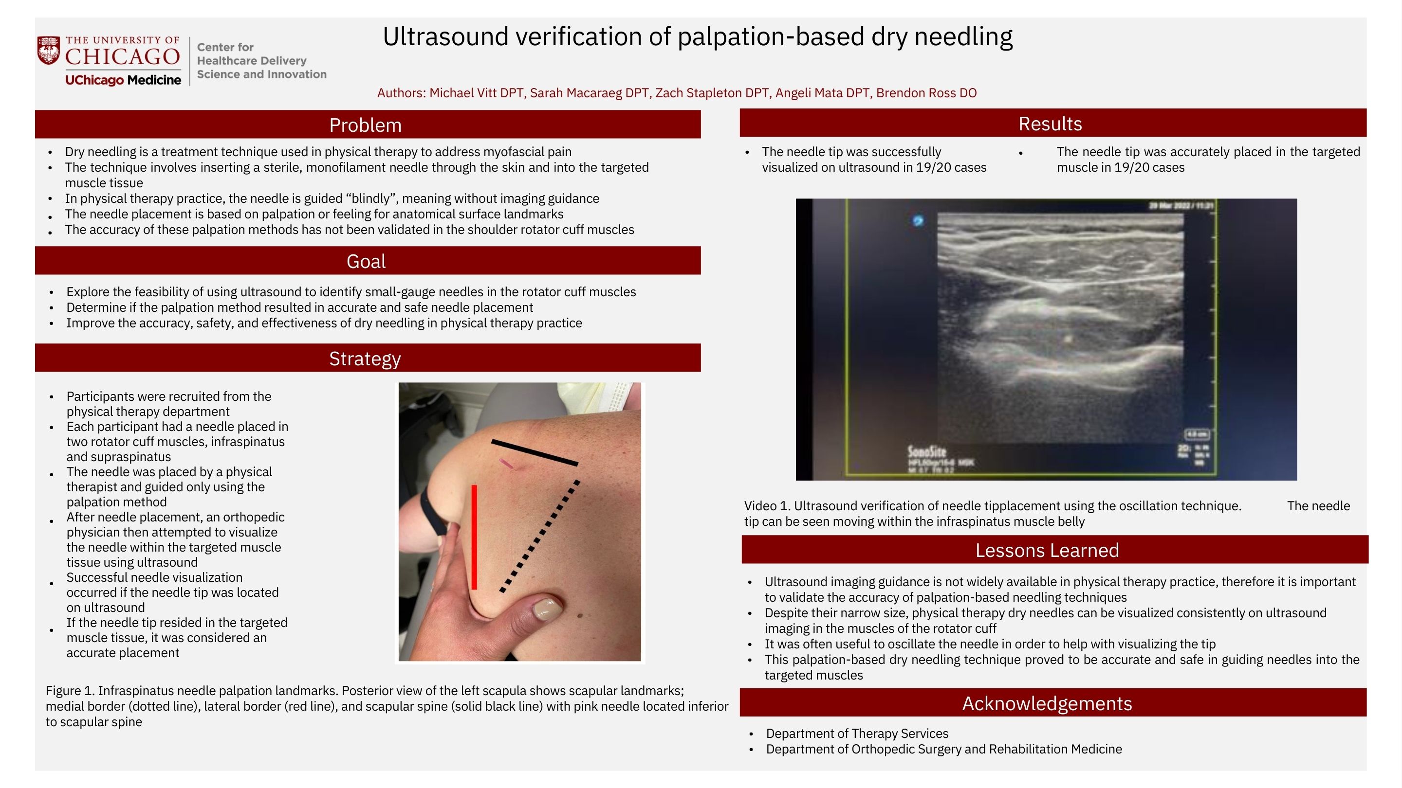 VITT_Ultrasound Verification of Palpation Based Dry Needling